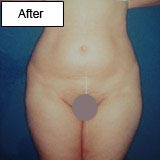 Lipoaspiration