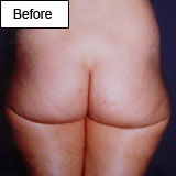 Lipoaspiration