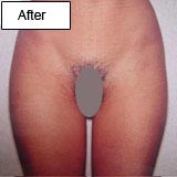 Lipoaspiration