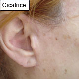 13 3 4 cicatrice